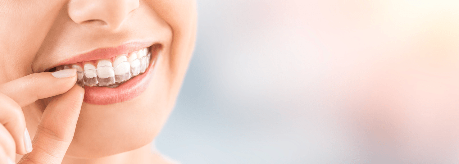 Ultimate Guide to Invisalign Clear Aligners